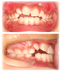 乳歯と永久歯が混ざっている時期（6歳〜12歳）から始める治療